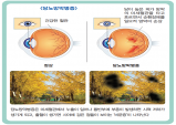 상주시, 당뇨합병증 예방을 위한 무료 안저검사